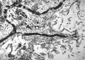  F,11y. | ependymoma